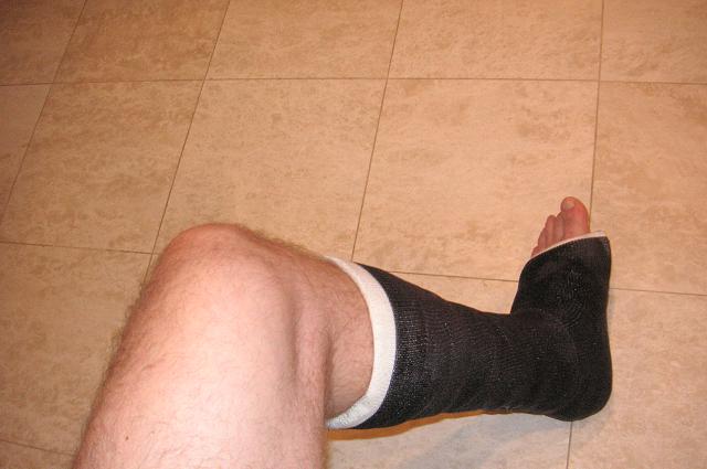 Ooops, left distal fractured fibula!
